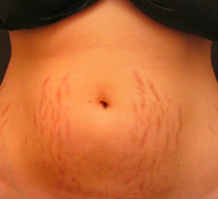 1690277061_Before stretch marks reduction.png